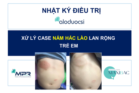 [𝐍𝐇𝐀̣̂𝐓 𝐊𝐘́ Đ𝐈𝐄̂̀𝐔 𝐓𝐑𝐈̣] XỬ LÝ CASE NẤM HẮC LÀO LAN RỘNG Ở TRẺ NHỎ