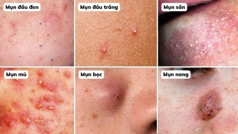 Những sai lầm trong điều trị mụn trứng cá tại nhà