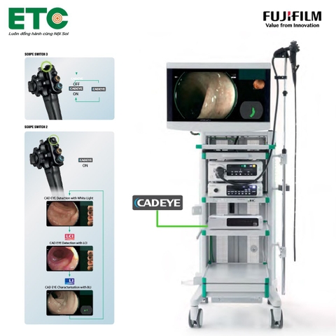 CADEYE-Nội soi kết hợp trí thông minh nhân tạo (AI)
