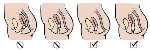 Cốc nguyệt san bị vướng: 5 nguyên nhân và cách khắc phục tức thì