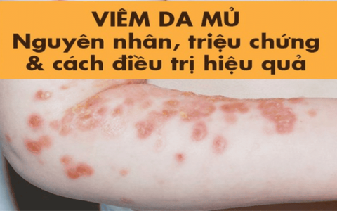 CÁCH PHÒNG BỆNH VIÊM DA MỦ KHI THỜI TIẾT NÓNG NỰC