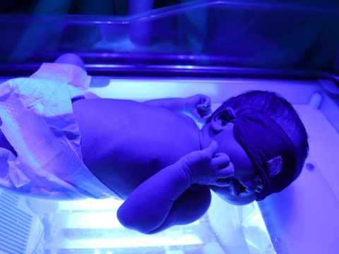 Chiếu đèn điều trị vàng da ở trẻ sơ sinh
