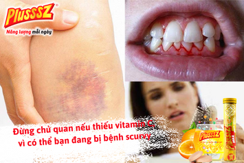 Đừng chủ quan nếu thiếu vitamin C, vì có thể bạn đang bị bệnh scurvy