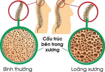 Thiếu hụt canxi và bổ sung thế nào cho đúng?