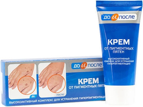 Kem Trị Đồi Mồi Tay Kpem Nga 50ml