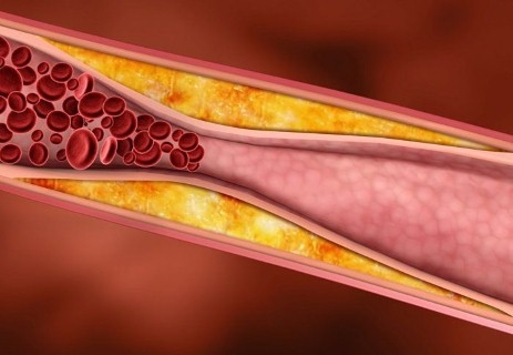 XƠ VỮA ĐỘNG MẠCH & GIẢI PHÁP