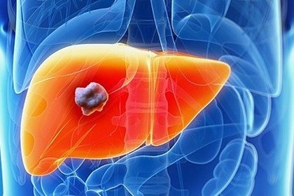 UNG THƯ GAN – THỰC TRẠNG ĐÁNG BÁO ĐỘNG TẠI VIỆT NAM VÀ CÁCH PHÒNG NGỪA.