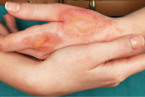 Chất hấp thụ để điều trị viêm da dị ứng