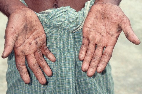 Làm sao để biết bạn đã nhiễm độc chì hay chưa?