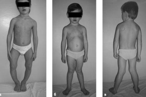 Nhiều phụ nữ và trẻ em ở Việt Nam bị thiếu hụt vitamin D và canxi