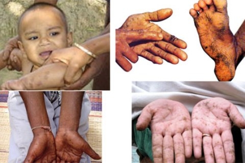 Nhiễm độc chì - cảnh báo nguy hiểm bị bỏ qua