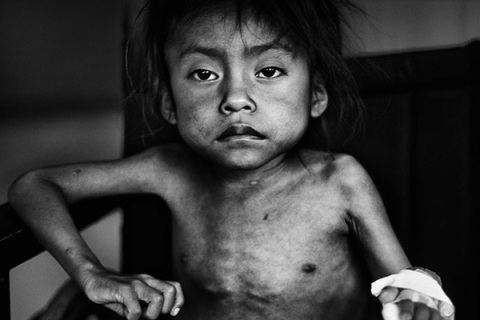 CỨU TRẺ EM NHIỄM ĐỘC CHÌ TẠI THÔN ĐÔNG MAI