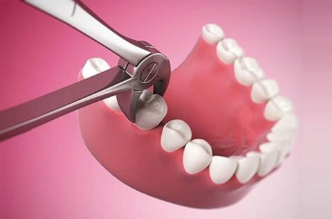 Mất răng số 6 hàm dưới có sao không,có niềng răng được không? Mất 2 răng số 6 hàm dưới sẽ thế nào?