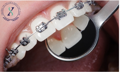 Niềng răng : 5 điều cần lưu ý khi chỉnh nha