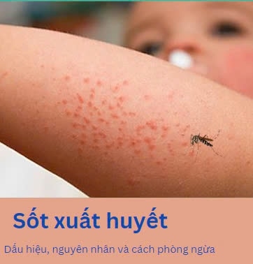 SỐT XUẤT HUYẾT, DẤU HIỆU, NGUYÊN NHÂN VÀ CÁCH PHÒNG NGỪA