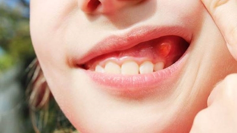 Khối u răng hàm mặt là gì? Các dấu hiệu ung thư răng hàm mặt