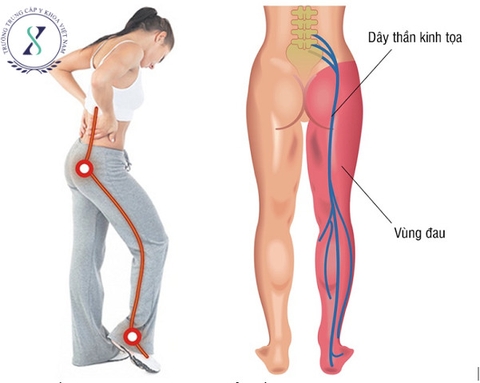 Chữa đau thần kinh tọa theo phương pháp y cổ truyền