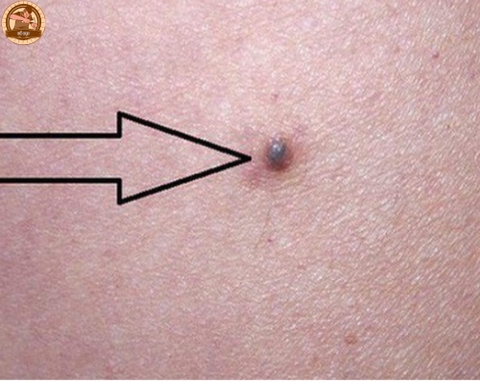 Nốt ruồi xanh có phải bệnh? Giải mã ý nghĩa của nốt ruồi này