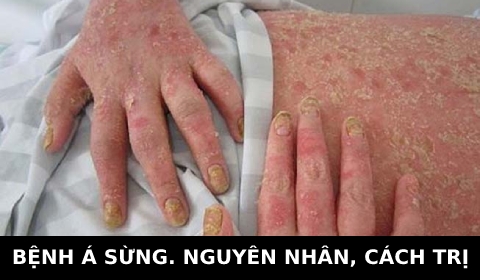 BỆNH Á SỪNG. KIẾN THỨC THỢ TÓC CẦN BIẾT