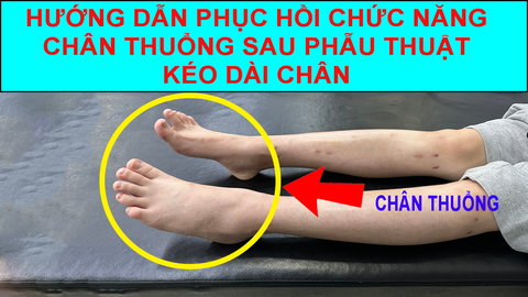 Phục Hồi Chức Năng Chân Thuổng Sau Phẫu Thuật Kéo Dài Chân