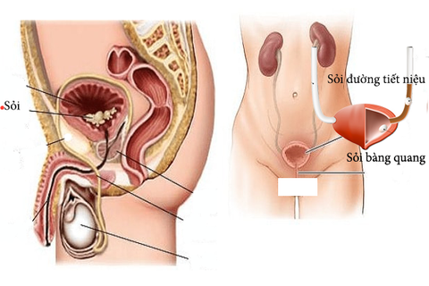 TRIỆU CHỨNG, BIỂU HIỆN CỦA SỎI BÀNG QUANG