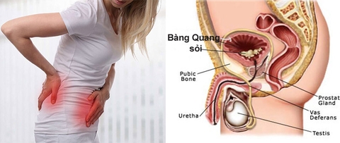 TÌM HIỂU VỀ SỎI BÀNG QUANG
