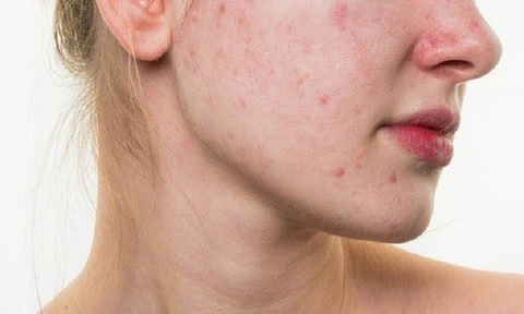 CÁC LOẠI MỤN THƯỜNG GẶP VÀ NHỮNG YẾU TỐ LIÊN QUAN ĐẾN MỤN