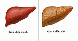 NGUY HẠI KHÔN LƯỜNG VÌ GAN NHIỄM MỠ