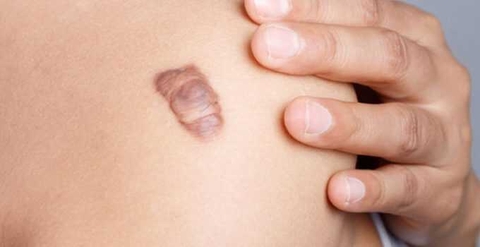 Sẹo là gì? Các loại sẹo và cách điều trị sẹo hiệu quả