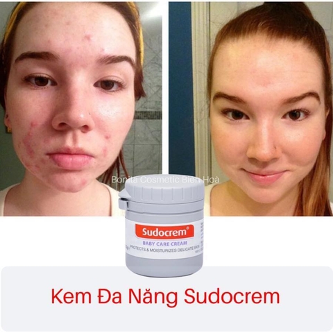 KEM CHỐNG HAM TÃ SUDOCREM ANH QUỐC ( Vết con trùng đốt , trĩ )