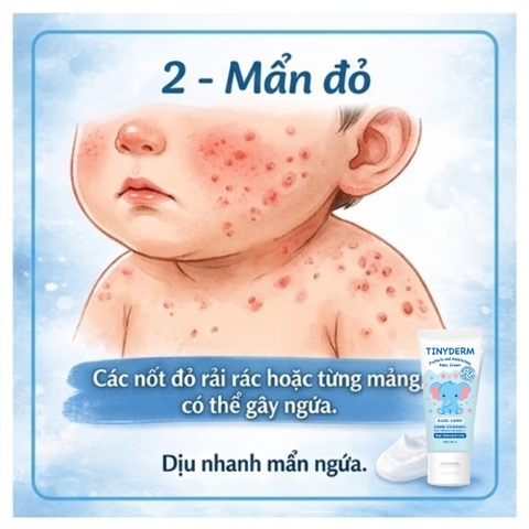 TinyDerm – Kem Phục Hồi Da Bé Dị Ứng Đạm Sữa Bò Nặng | Prebiotics + Postbiotics Nhật Bản Giúp Da Khỏe Từ Gốc 