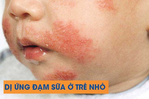 Sữa Gạo Novalac Riz Chính Hãng 2025: Review Chi Tiết, Giá Bán, Thành Phần, Lợi Ích, Cách Pha Cho Bé Dị Ứng Đạm Sữa Bò, Không Dung Nạp Lactose