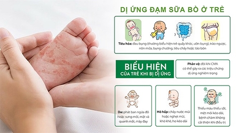 Sữa Meiji HP Cho Bé Dị Ứng Đạm Sữa Bò 800g Chính Hãng 2025: Review Chi Tiết, Giá Bán, Thành Phần, Lợi Ích, Cách Pha Cho Bé Dị Ứng Đạm Sữa Bò
