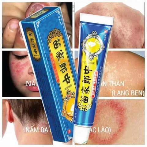 KEM HỖ TRỢ GIẢM BỆNH NGOÀI DA, NẤM, VẨY, LANG BEN VV… '