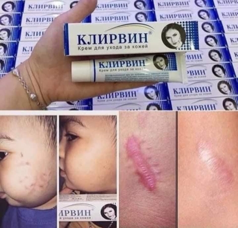KEM HỖ TRỢ GIẢM SẸO NGA XỊN (5) '