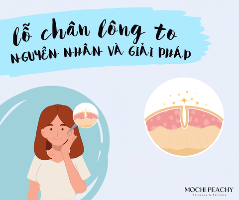 LỖ CHÂN LÔNG TO: NGUYÊN NHÂN VÀ GIẢI PHÁP