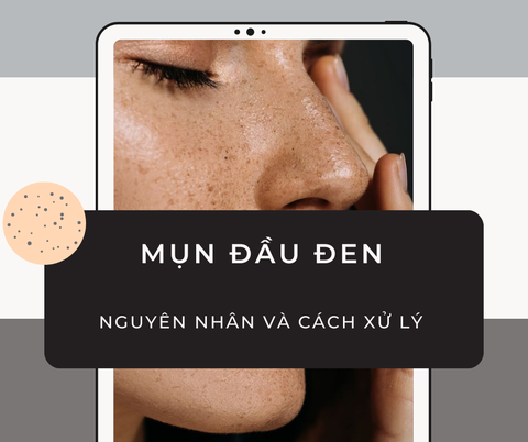 MỤN ĐẦU ĐEN - NGUYÊN NHÂN VÀ CÁCH XỬ LÝ