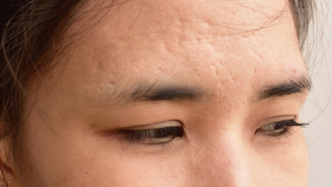 Bị sẹo rỗ bao lâu thì khỏi? Tinh chất FaceSkin 3.0 hỗ trợ làm phẳng và mờ sẹo rỗ