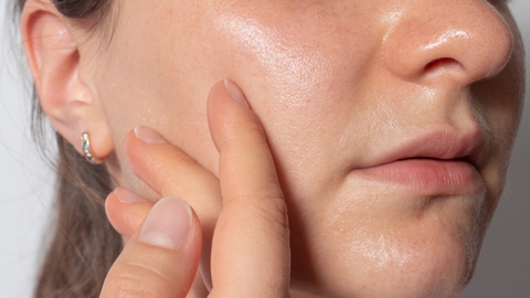 Da dầu mụn là gì? Cách chăm sóc giúp kiềm dầu, giảm mụn