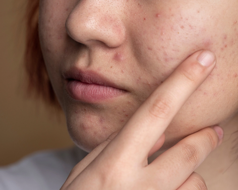 Da Mụn Có Nên Peel Da Sinh Học Không? Cơ Chế Và Lợi Ích Vượt Trội