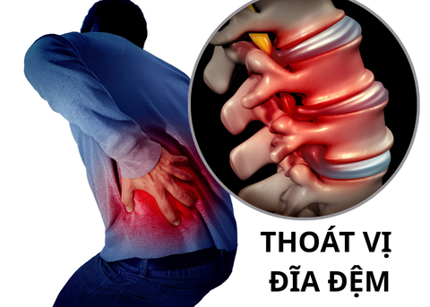 Có Nên Điều Trị Thoát Vị Đĩa Đệm Bằng Huyết Tương Giàu Tiểu Cầu PRP? Những Điều Cần Biết