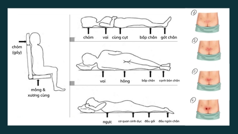 Làm gì khi bị loét tì đè? Phòng ngừa loét tì đè hiệu quả
