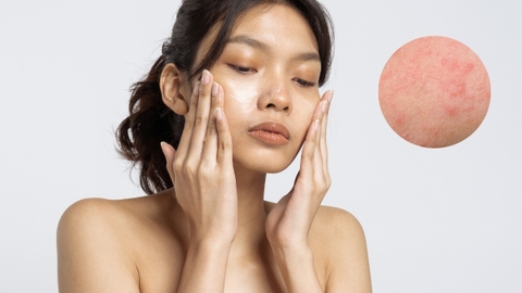 Nhận biết da bị kích ứng và cách phục hồi da bị kích ứng hiệu quả