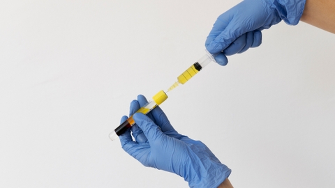 Phương pháp prp huyết tương giàu tiểu cầu điều trị thoái hóa khớp háng