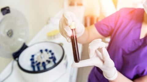 PRP treatment là gì? Ứng dụng PRP treatment trong lành vết thương