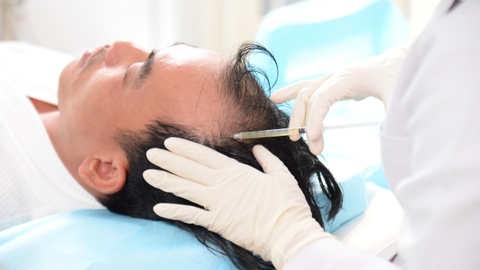 Rụng tóc ở nam giới: Nguyên nhân, triệu chứng và cách điều trị bệnh