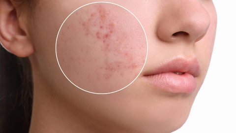 Sẹo lõm bôi gì giúp làm phẳng và mờ sẹo hiệu quả?