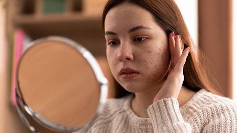 Sẹo lõm sau mụn và giải pháp làm đầy sẹo hiệu quả