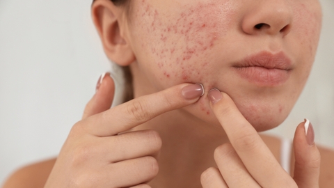 Sẹo mụn có tự hết được không? Cách làm mờ sẹo mụn hiệu quả