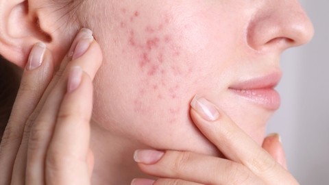 Tại sao cần phục hồi da sau mụn? Top 1 serum phục hồi da sau mụn cho da dầu